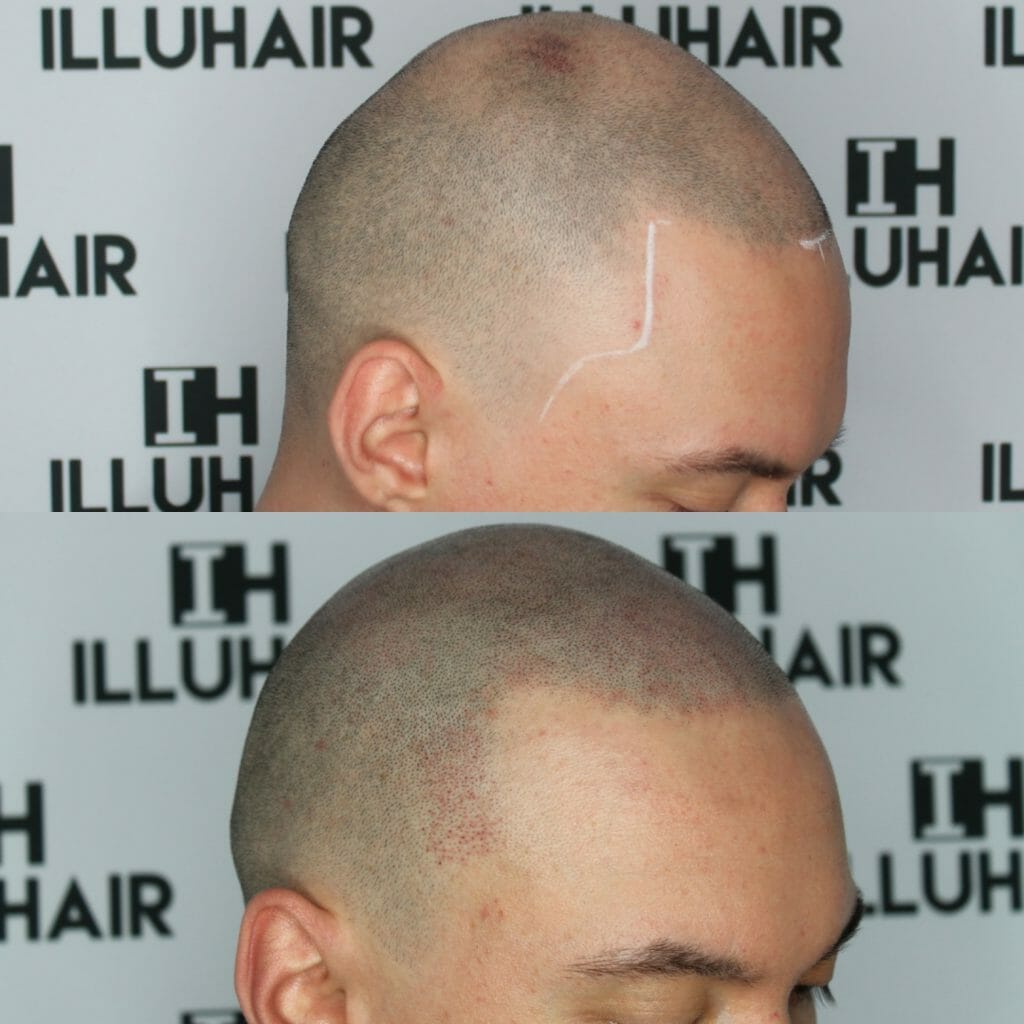   Effektiv behandling mot håravfall