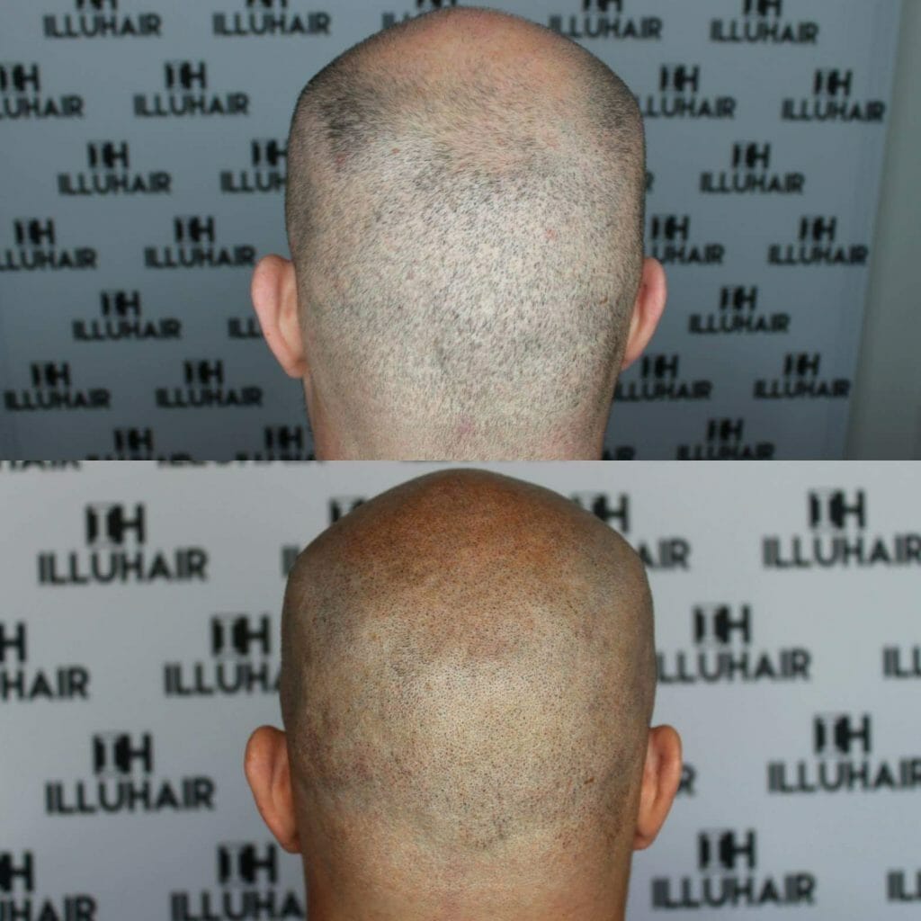 Effektiv behandling mot håravfall hos män