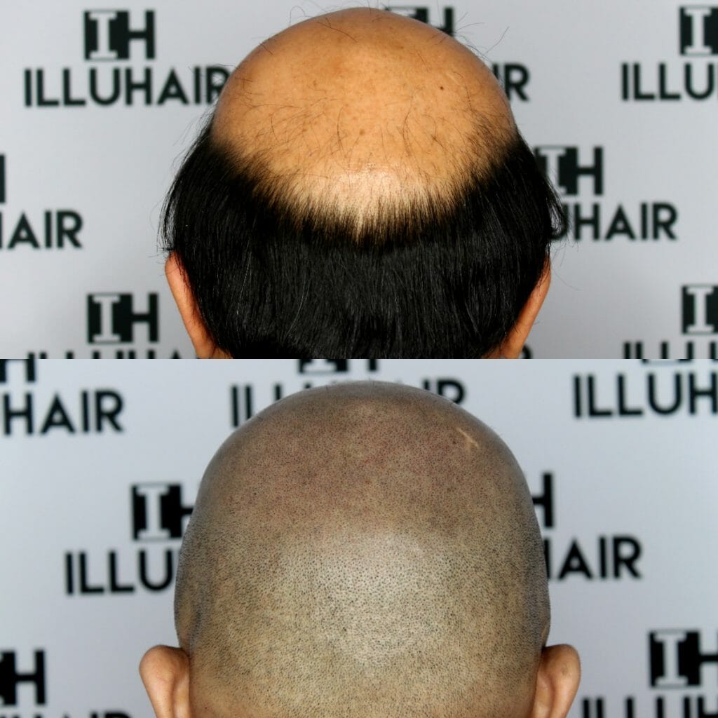 Illuhair scalp micropigmentation